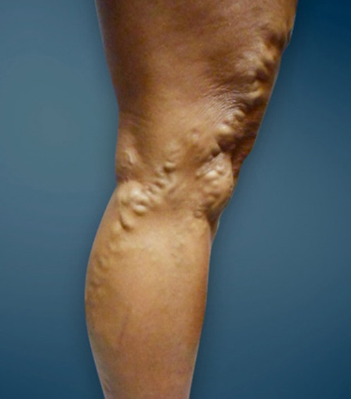 piciorul dureros în varicoza