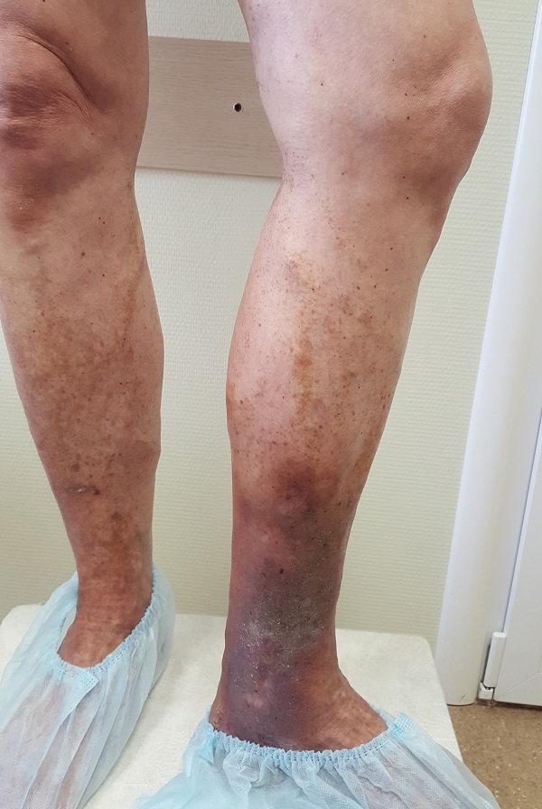 Трофическая венозная экзема