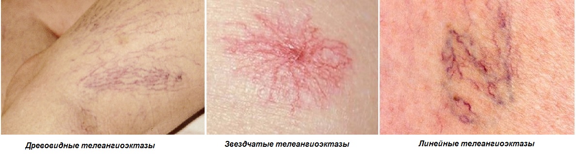 Разновидности телеангиоэктазов и звездочек