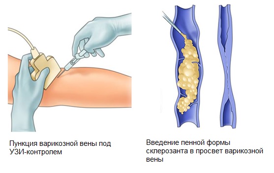 Склеротерапия вен нижних конечностей фото